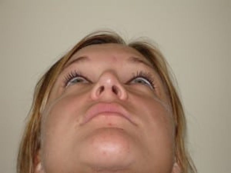 Rhinoplasty Before & After Gallery - Patient 133066734 - Image 10