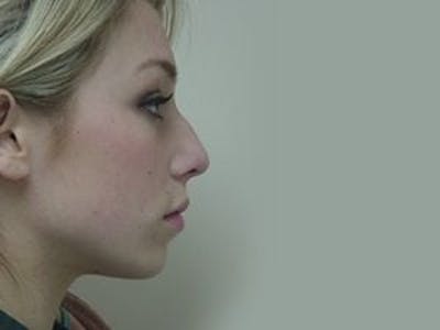 Rhinoplasty Before & After Gallery - Patient 133066735 - Image 1