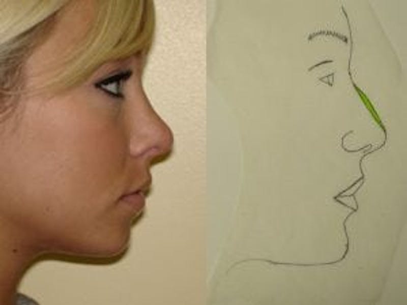 Rhinoplasty Before & After Gallery - Patient 133066735 - Image 2