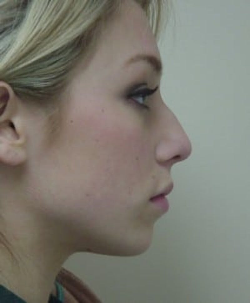 Rhinoplasty Before & After Gallery - Patient 133066735 - Image 3
