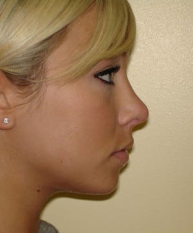 Rhinoplasty Before & After Gallery - Patient 133066735 - Image 4