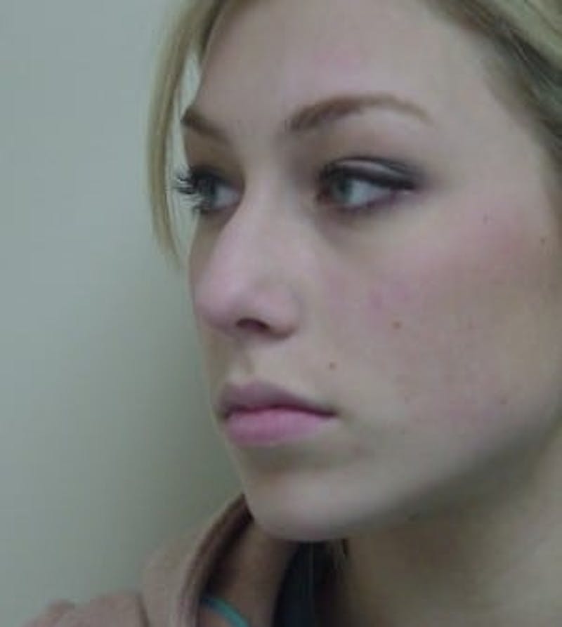 Rhinoplasty Before & After Gallery - Patient 133066735 - Image 5
