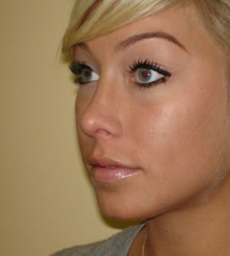 Rhinoplasty Before & After Gallery - Patient 133066735 - Image 6