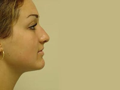 Rhinoplasty Before & After Gallery - Patient 133066737 - Image 1