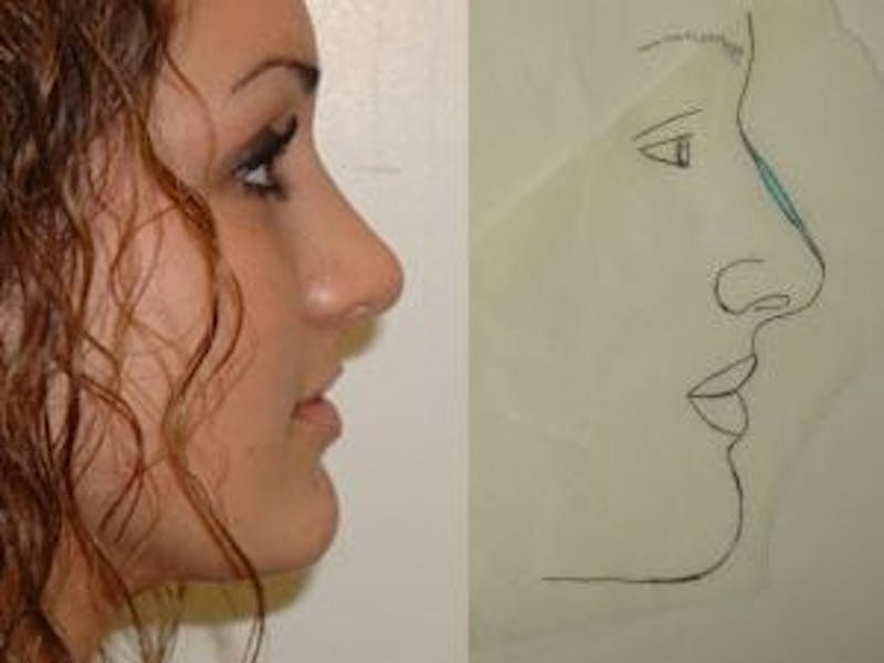 Rhinoplasty Before & After Gallery - Patient 133066737 - Image 2