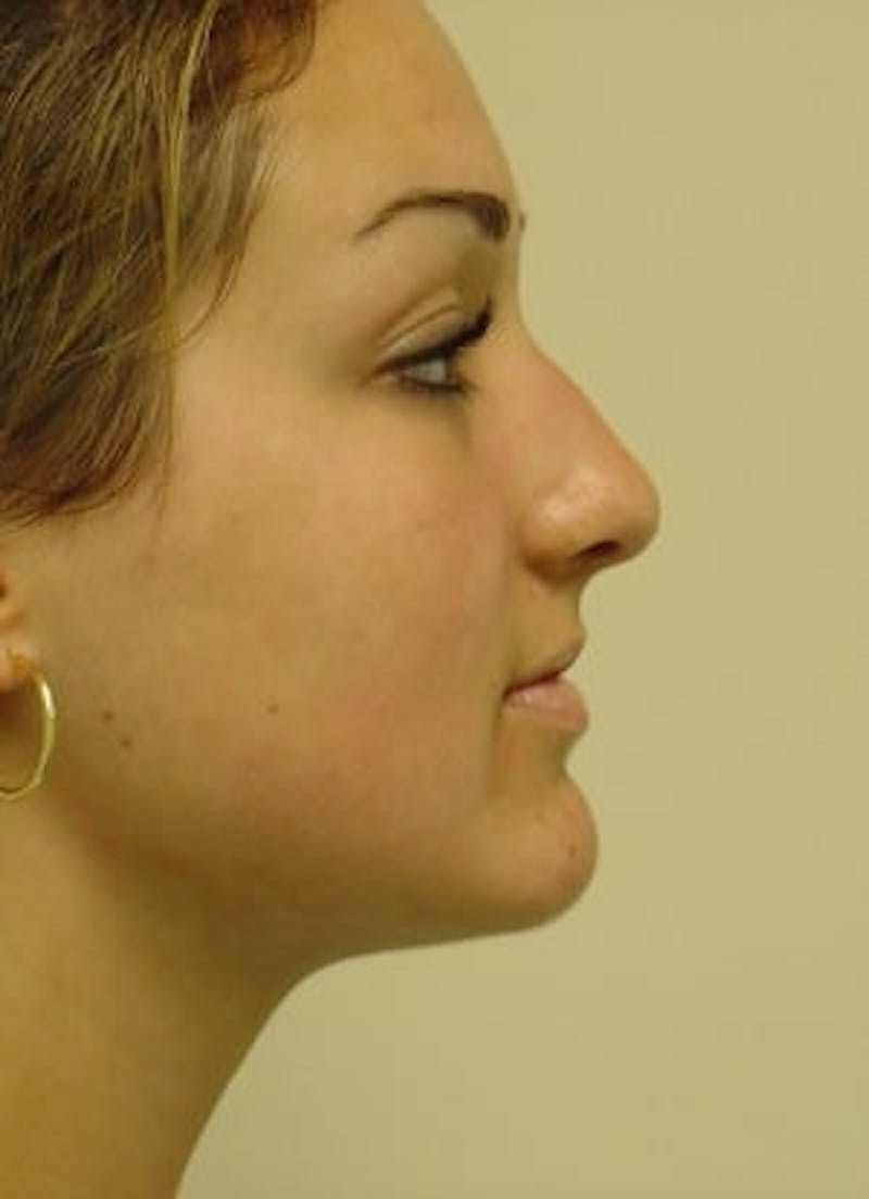 Rhinoplasty Before & After Gallery - Patient 133066737 - Image 3