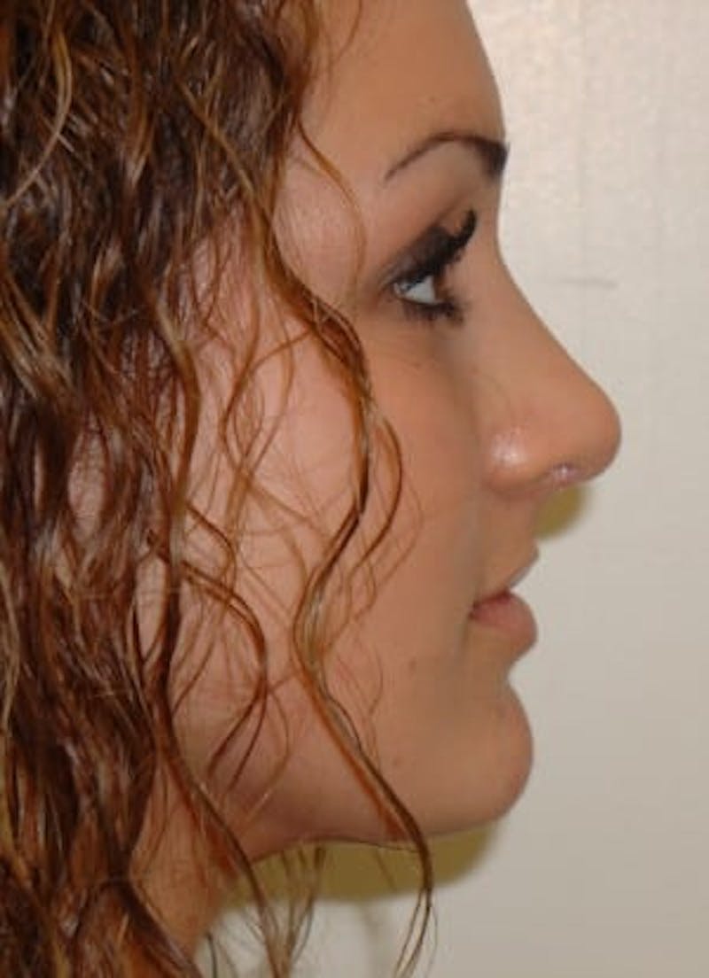 Rhinoplasty Before & After Gallery - Patient 133066737 - Image 4