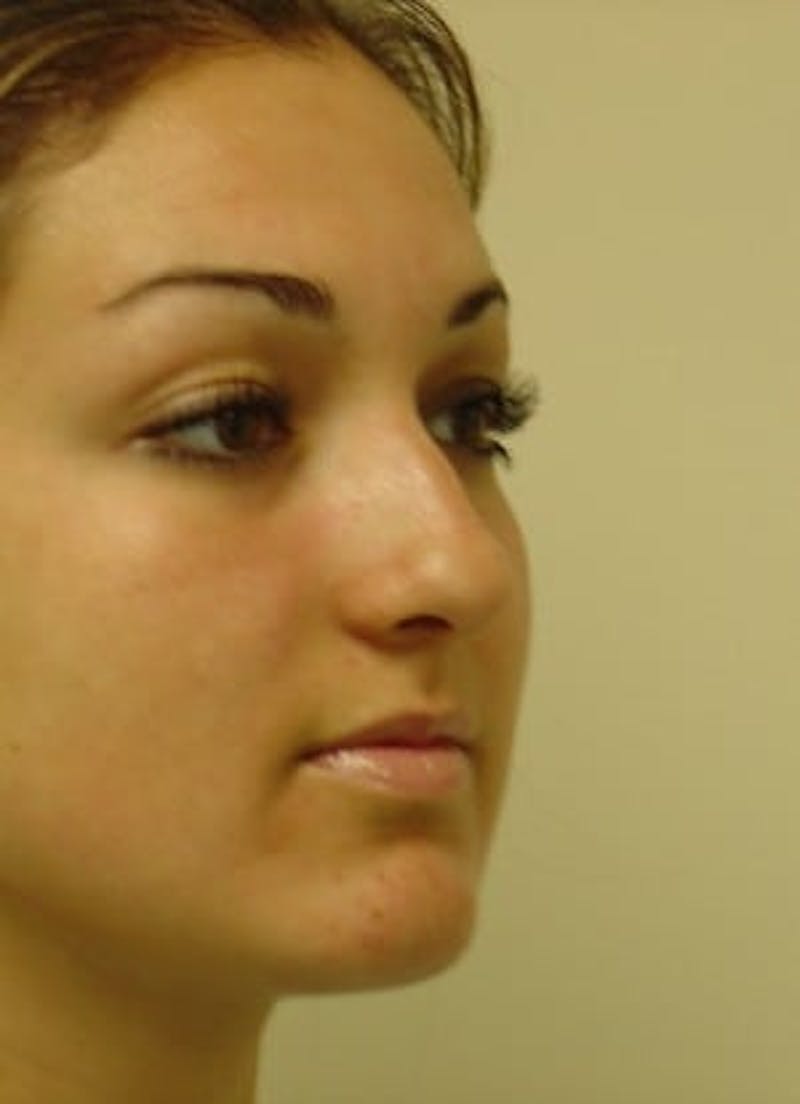 Rhinoplasty Before & After Gallery - Patient 133066737 - Image 5