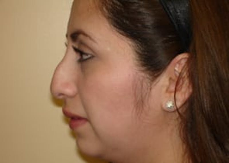 Rhinoplasty Before & After Gallery - Patient 133066738 - Image 1