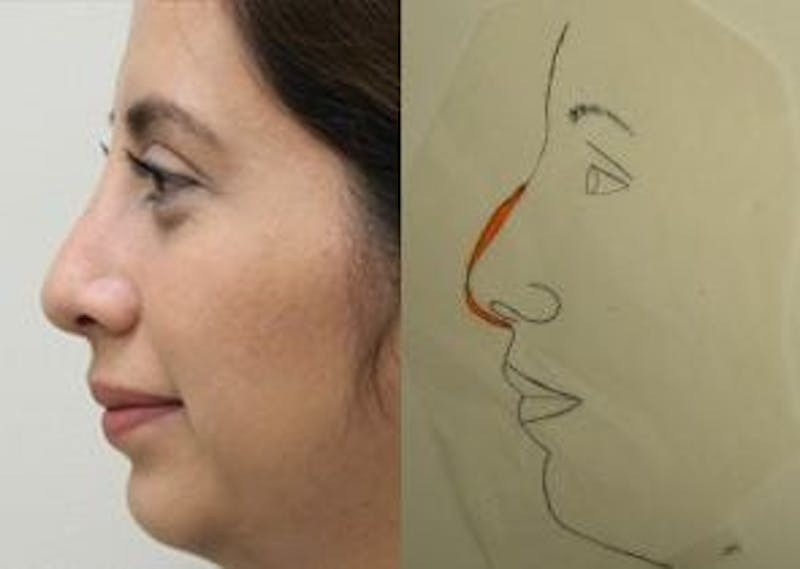 Rhinoplasty Before & After Gallery - Patient 133066738 - Image 2
