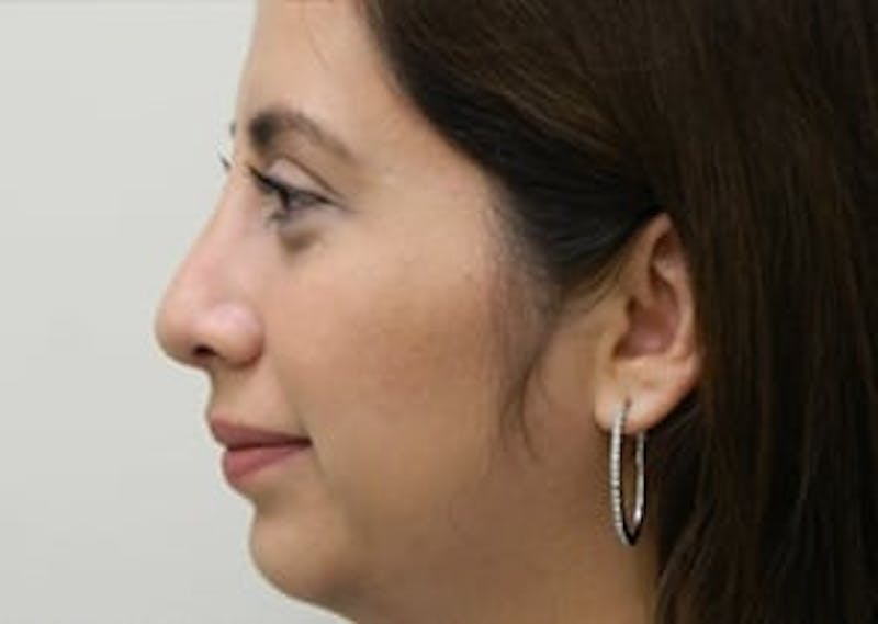 Rhinoplasty Before & After Gallery - Patient 133066738 - Image 4