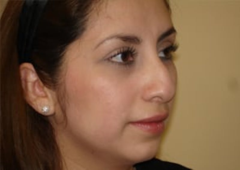 Rhinoplasty Before & After Gallery - Patient 133066738 - Image 5
