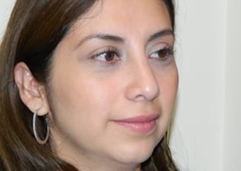 Rhinoplasty Before & After Gallery - Patient 133066738 - Image 6