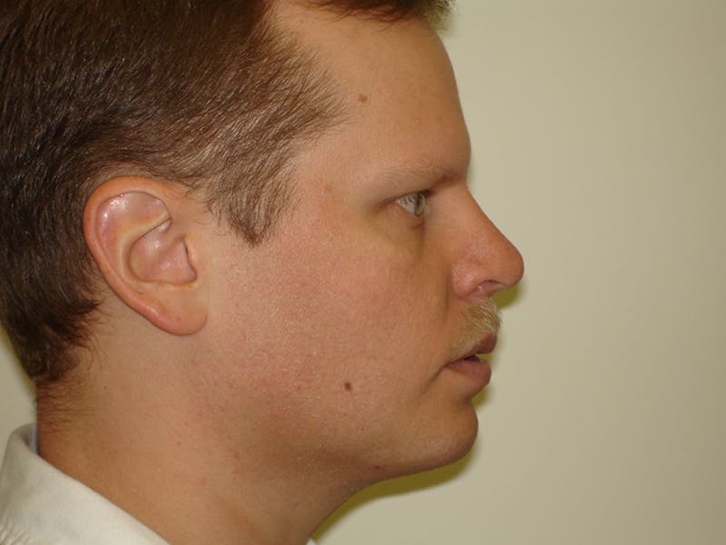 Rhinoplasty Before & After Gallery - Patient 133066742 - Image 4