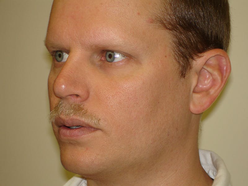 Rhinoplasty Before & After Gallery - Patient 133066742 - Image 6