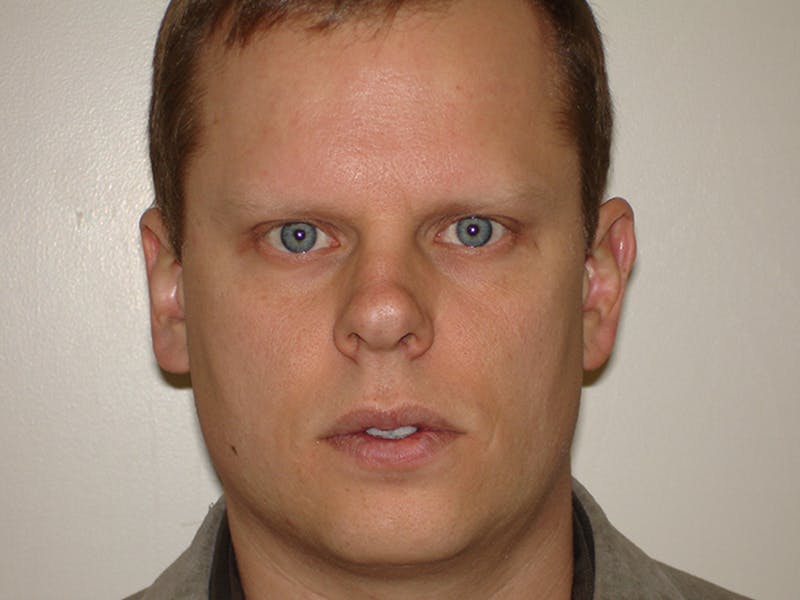 Rhinoplasty Before & After Gallery - Patient 133066742 - Image 7