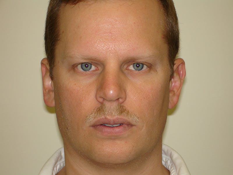 Rhinoplasty Before & After Gallery - Patient 133066742 - Image 8