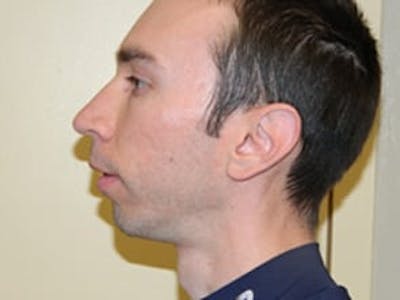 Rhinoplasty Before & After Gallery - Patient 133066743 - Image 1