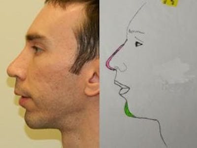 Rhinoplasty Before & After Gallery - Patient 133066743 - Image 2