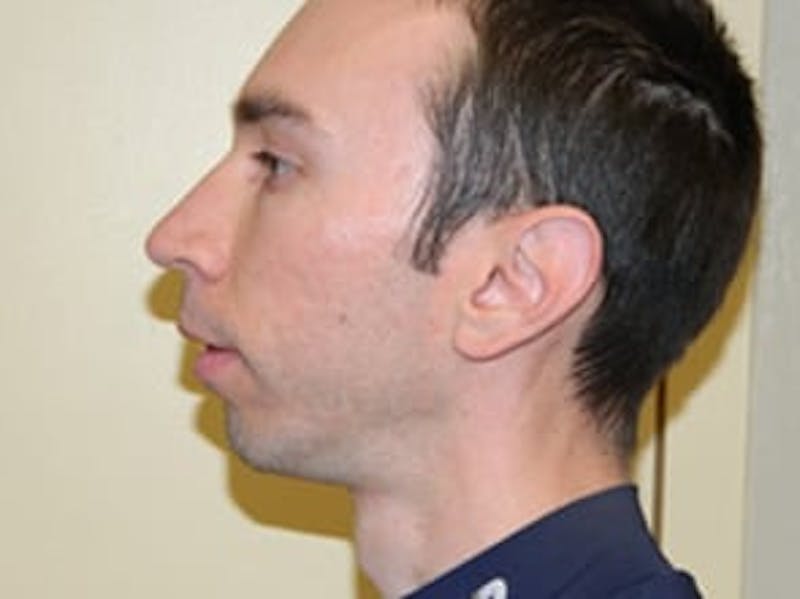 Rhinoplasty Before & After Gallery - Patient 133066743 - Image 3