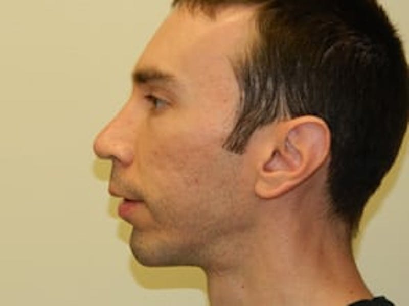 Rhinoplasty Before & After Gallery - Patient 133066743 - Image 4