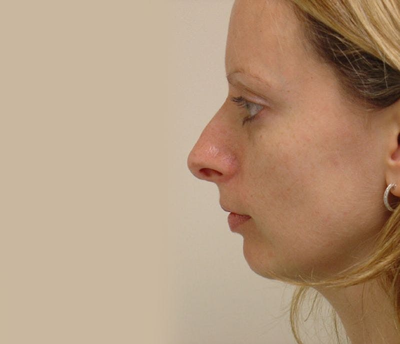 Rhinoplasty Before & After Gallery - Patient 133066745 - Image 1