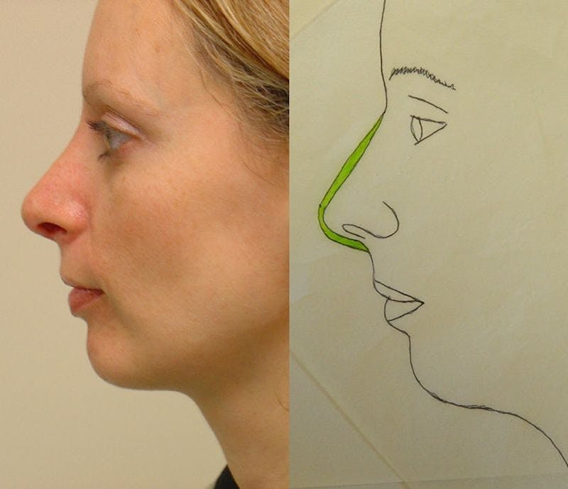Rhinoplasty Before & After Gallery - Patient 133066745 - Image 2