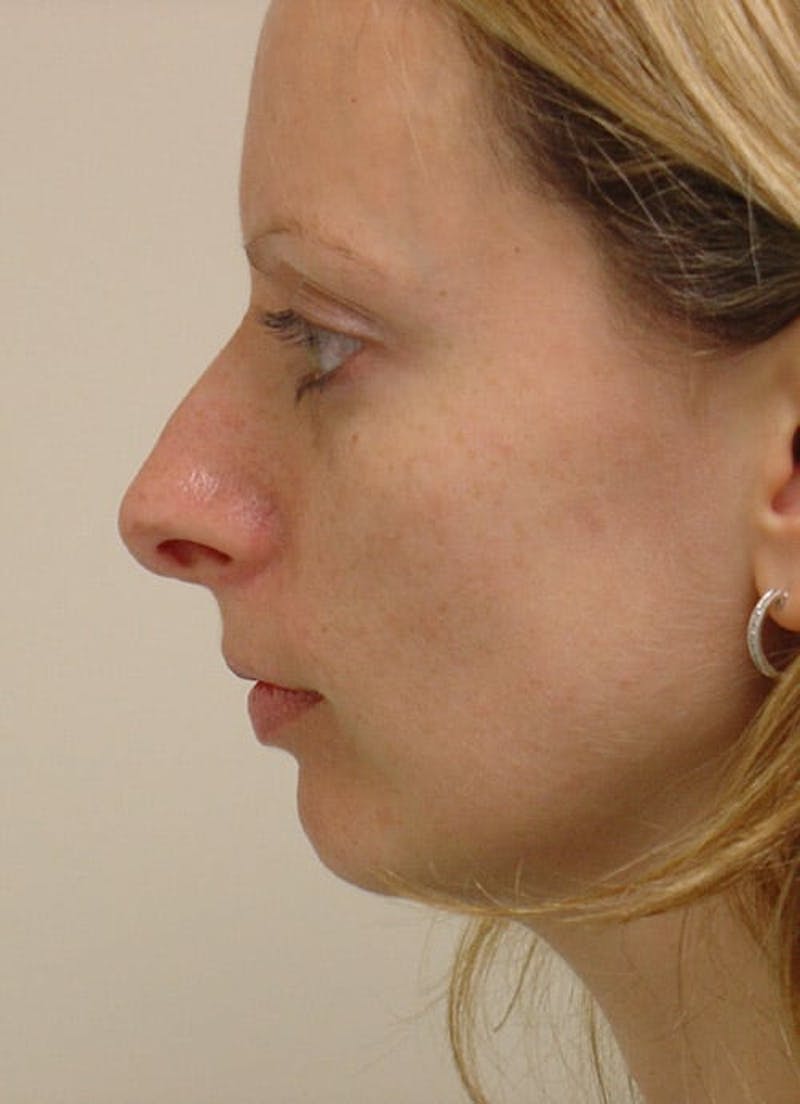 Rhinoplasty Before & After Gallery - Patient 133066745 - Image 3