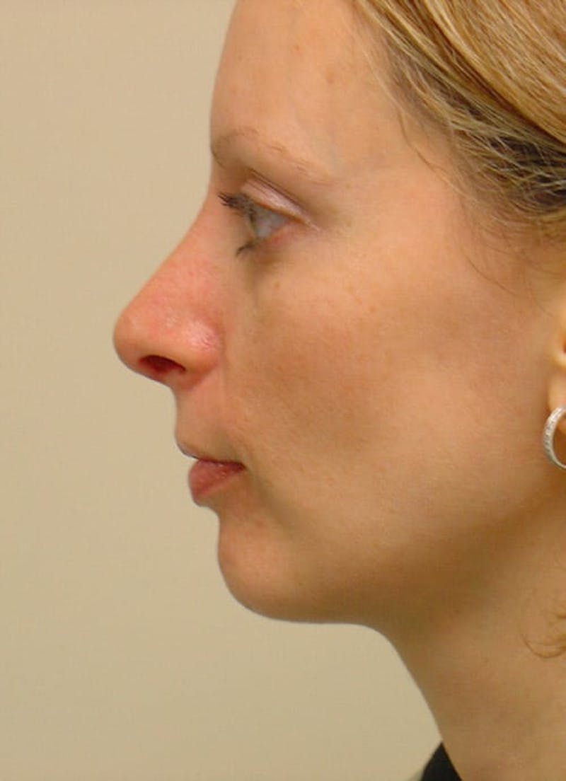 Rhinoplasty Before & After Gallery - Patient 133066745 - Image 4