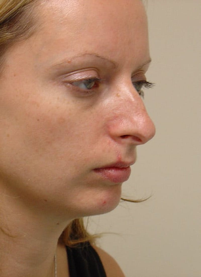 Rhinoplasty Before & After Gallery - Patient 133066745 - Image 5