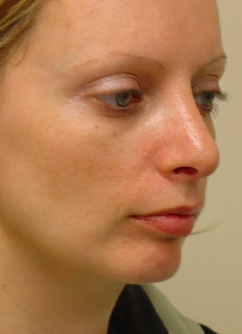 Rhinoplasty Before & After Gallery - Patient 133066745 - Image 6