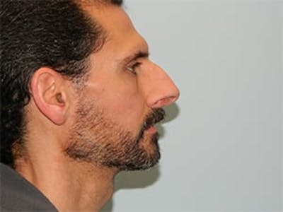 Rhinoplasty Before & After Gallery - Patient 133066746 - Image 1