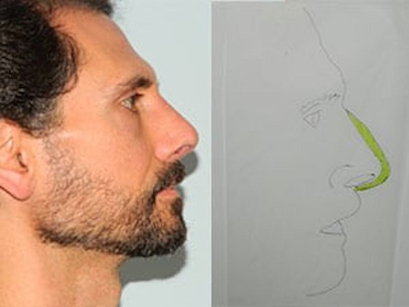 Rhinoplasty Before & After Gallery - Patient 133066746 - Image 2