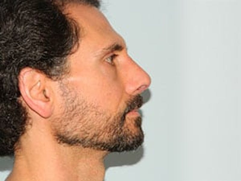Rhinoplasty Before & After Gallery - Patient 133066746 - Image 4