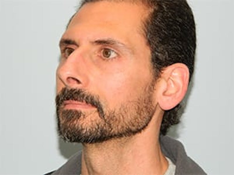 Rhinoplasty Before & After Gallery - Patient 133066746 - Image 5