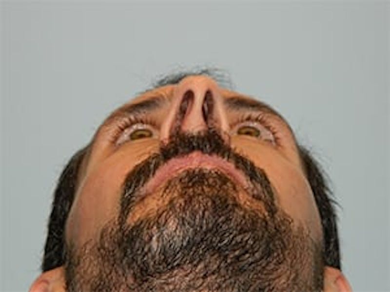 Rhinoplasty Before & After Gallery - Patient 133066746 - Image 9