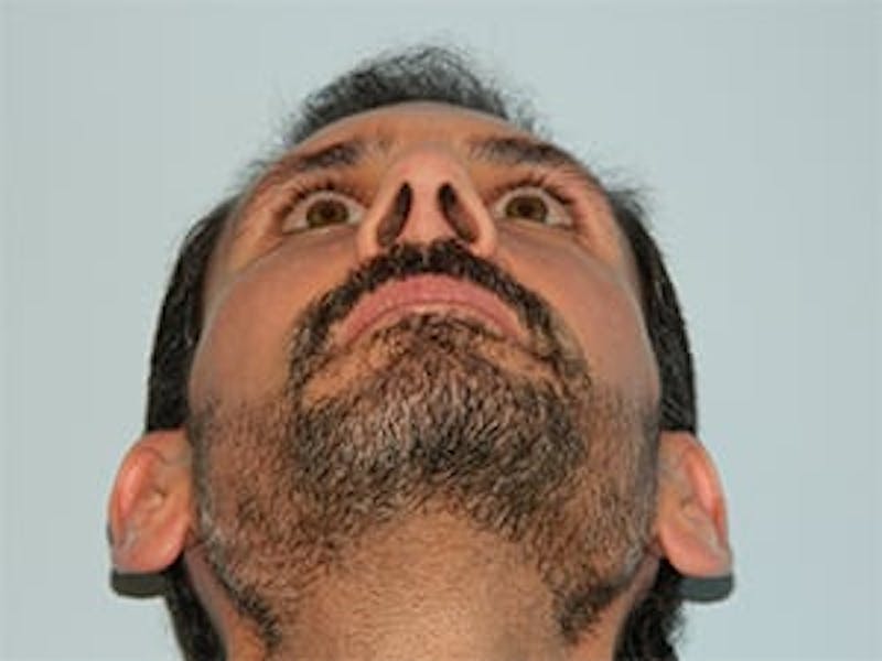 Rhinoplasty Before & After Gallery - Patient 133066746 - Image 10
