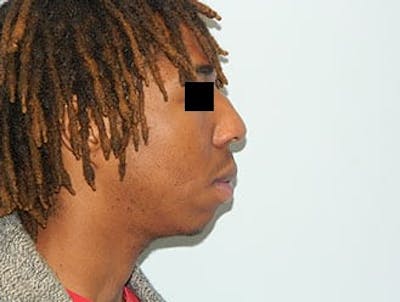 Rhinoplasty Before & After Gallery - Patient 133066748 - Image 1