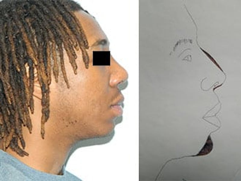 Rhinoplasty Before & After Gallery - Patient 133066748 - Image 2