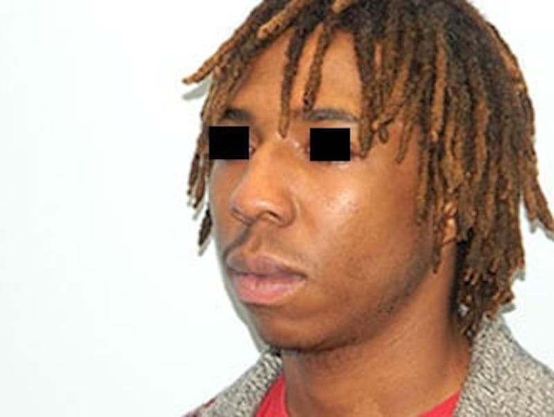 Rhinoplasty Before & After Gallery - Patient 133066748 - Image 3