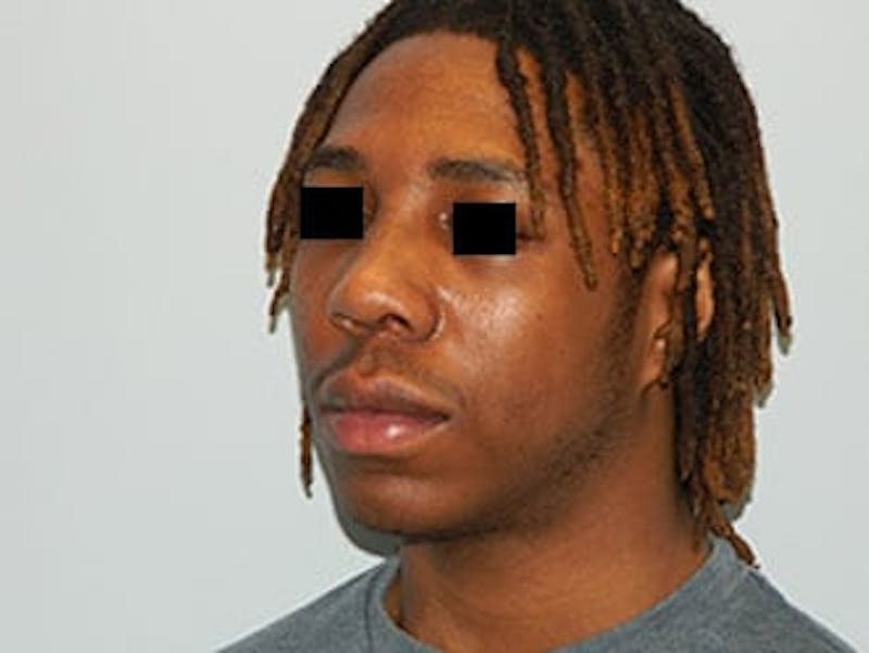 Rhinoplasty Before & After Gallery - Patient 133066748 - Image 4