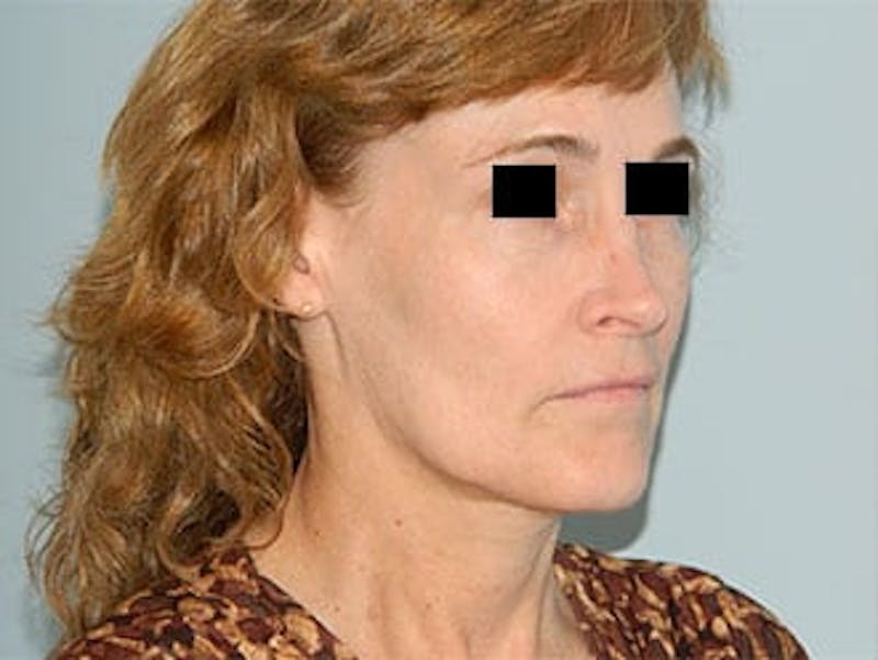 Rhinoplasty Before & After Gallery - Patient 133066749 - Image 3