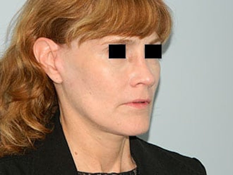 Rhinoplasty Before & After Gallery - Patient 133066749 - Image 4