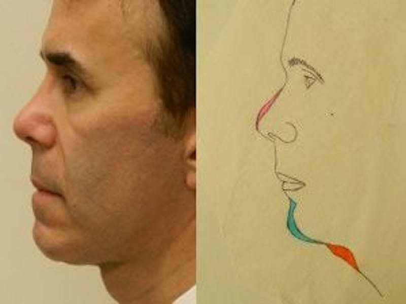 Rhinoplasty Before & After Gallery - Patient 133066750 - Image 2