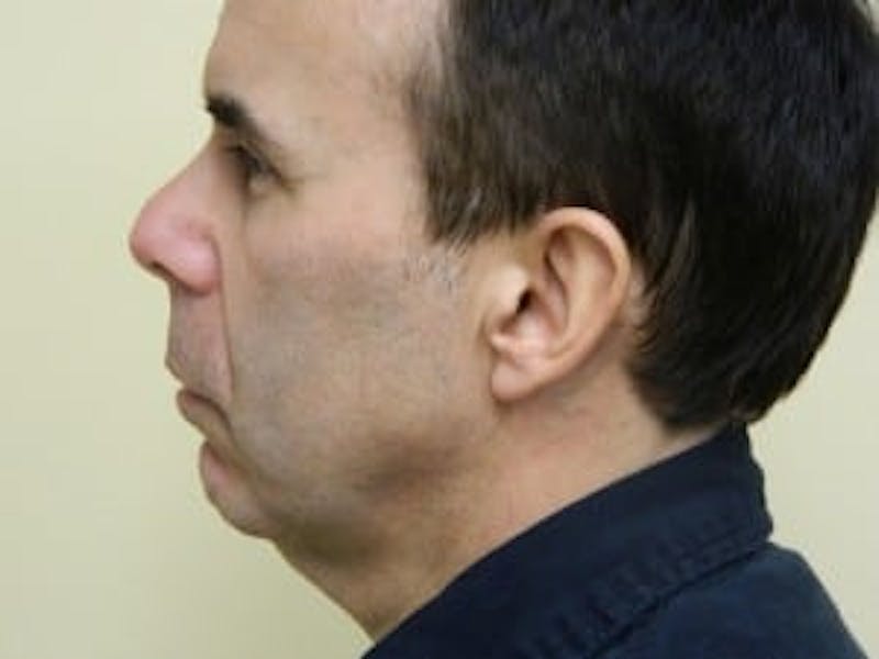 Rhinoplasty Before & After Gallery - Patient 133066750 - Image 3