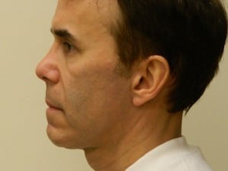 Rhinoplasty Before & After Gallery - Patient 133066750 - Image 4