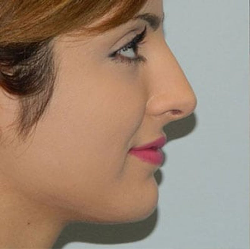 Rhinoplasty Before & After Gallery - Patient 133066751 - Image 1
