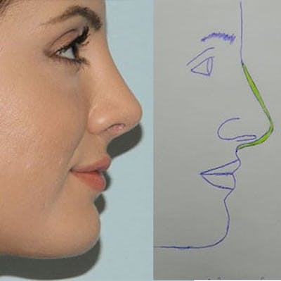 Rhinoplasty Before & After Gallery - Patient 133066751 - Image 2