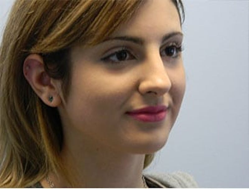 Rhinoplasty Before & After Gallery - Patient 133066751 - Image 3
