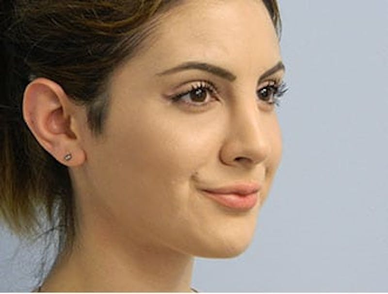 Rhinoplasty Before & After Gallery - Patient 133066751 - Image 4